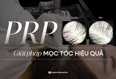 PRP: GIẢI PHÁP MỌC TÓC HIỆU QUẢ