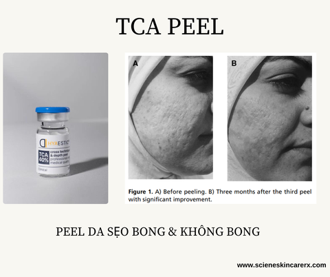 HIỆU QUẢ CỦA PHƯƠNG PHÁP ĐIỀU TRỊ SẸO MỤN BẰNG PEEL DA
